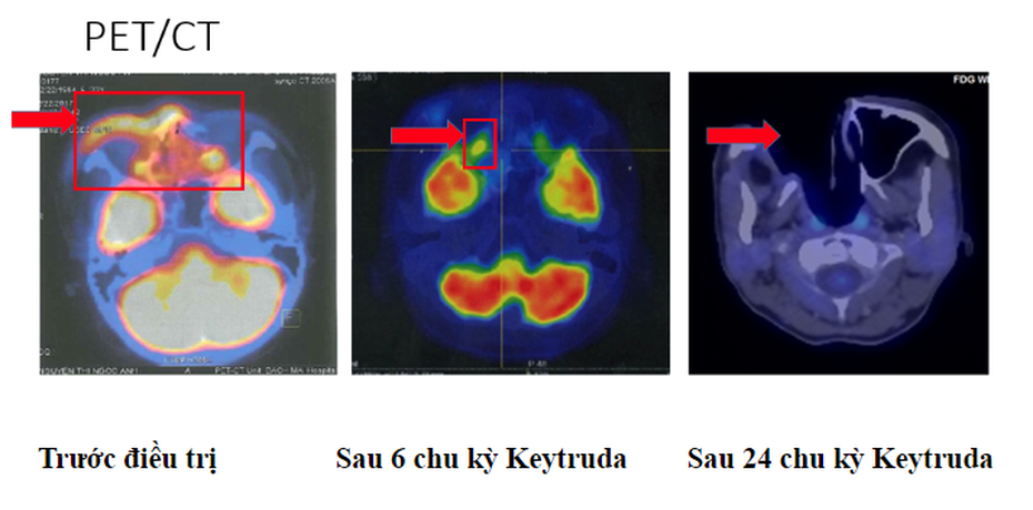 Thuốc miễn dịch kéo dài thời gian sống cho bệnh nhân ung thư giai đoạn muộn