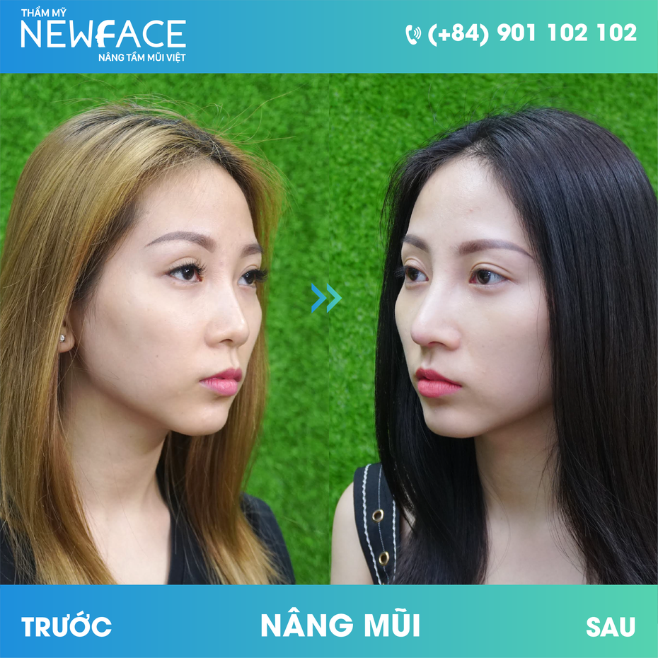 Nguyễn Thủy: “Tôi đã thực sự lột xác thần kỳ sau nâng mũi tại Thẩm mỹ NEWFACE