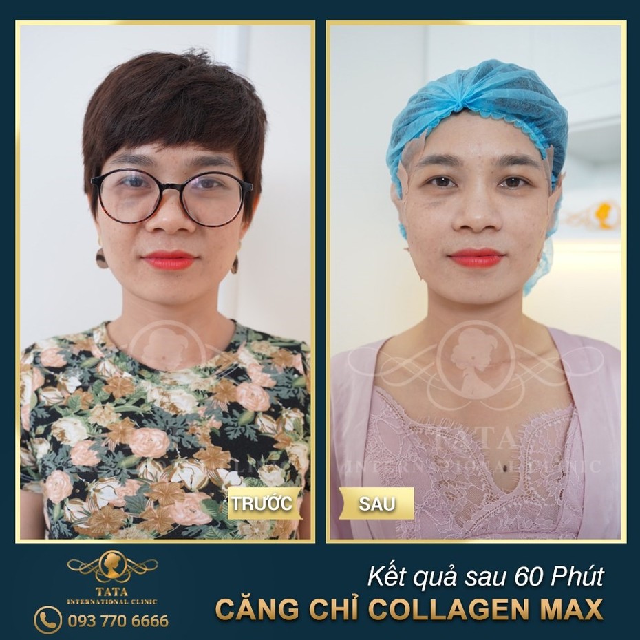 Bỏ qua phẫu thuật căng da mặt đi, căng da không xâm lấn bằng chỉ phễu Collagen Max mới đang là xu thế mới
