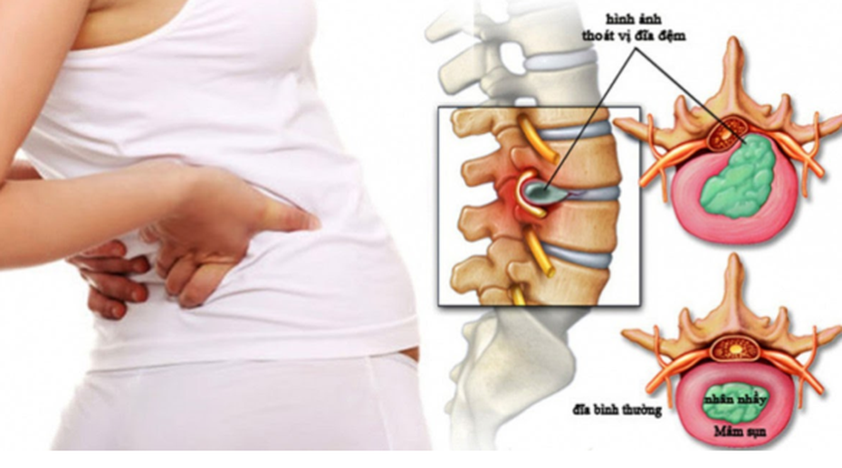 Bị thoát vị đĩa đệm cổ - Đừng lo đã có Cốt Thoái Vương?