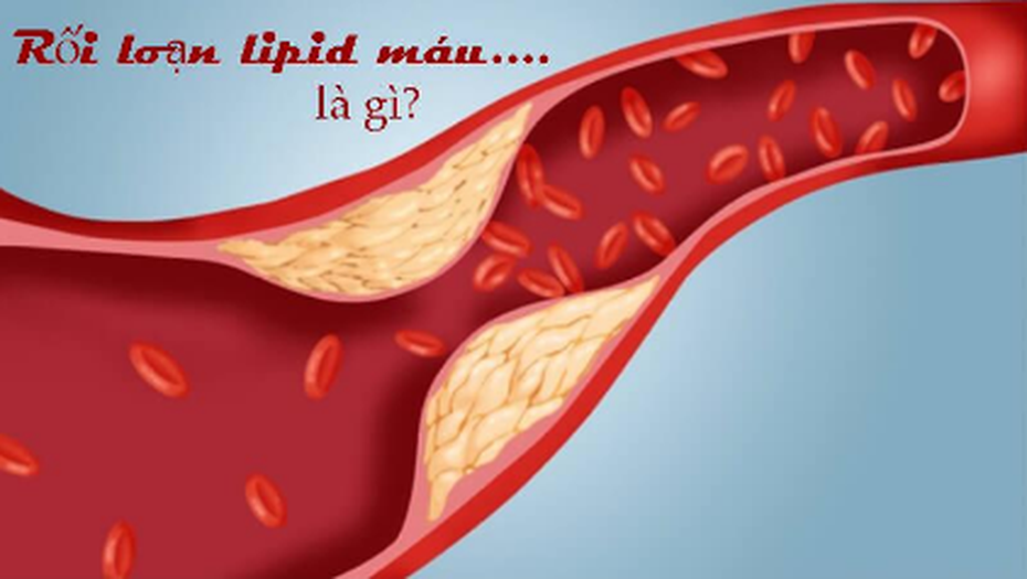 Tại sao Lipidcleanz là công thức độc đáo cho người rối loạn lipid máu?