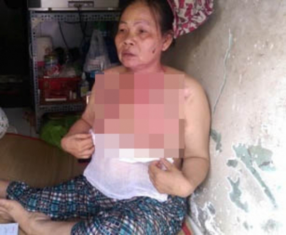 Chủ nhà bị người thuê trọ tạt nước sôi vì… đòi tiền nhà