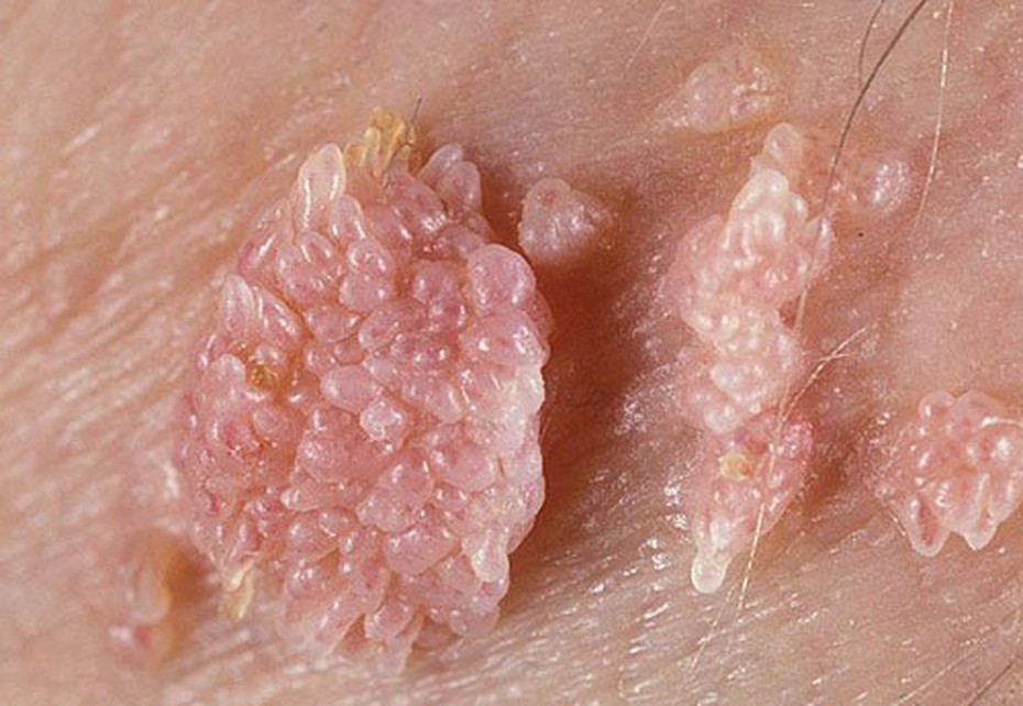 Bé trai 6 tuổi bị sùi mào gà, bố mẹ ngơ ngác nhìn nhau