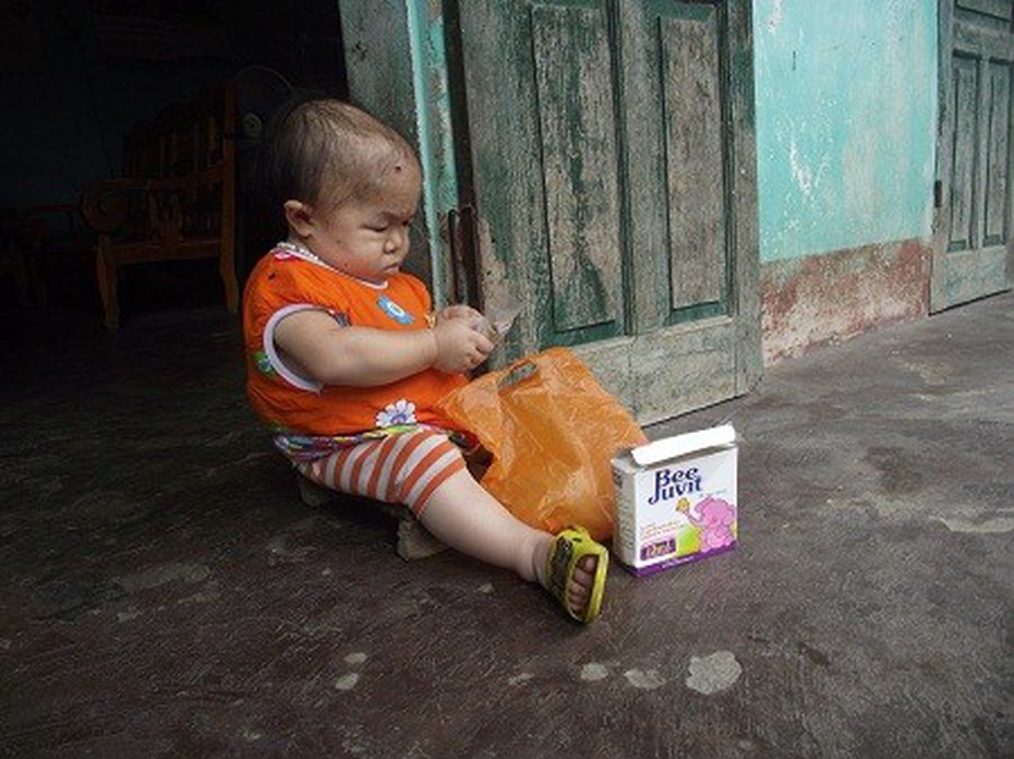 Cô gái 22 tuổi mang thân hình đứa trẻ và khuôn mặt bà già