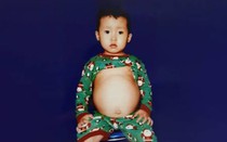 Bé trai 4 tuổi bị gan, thận to bất thường cần tiền để phẫu thuật