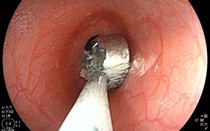 Bé gái 19 tháng tuổi nuốt phải cục pin trong lúc chơi