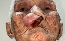 Phẫu thuật cho cụ bà gần 100 tuổi sau 30 năm sống chung với khối u trên mặt