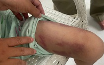 Vụ bé gái 9 tuổi bị bạo hành: Bắt tạm giam mẹ ruột và người tình