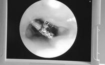 Người phụ nữ 65 tuổi ho suốt ngày, đến viện bác sĩ gắp ra thứ "đáng sợ" bên trong