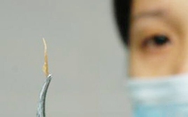 Suýt thủng phế quản vì… mảnh xương cá “đi lạc” suốt 3 tuần trong phổi