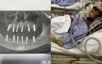 Người đàn ông tử vong sau khi cấy 6 implant và nhổ 12 răng cùng lúc