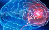 Người phụ nữ 57 tuổi bất ngờ phát hiện khối u não nhờ đồng hồ đeo tay