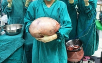 Người phụ nữ đi khám vì đau bụng, bác sĩ sốc nặng khi lấy ra thứ nặng 8kg