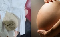 Đau vùng kín suốt 1 tháng sau sinh,người phụ nữ sốc nặng khi phát hiện "vật lạ" trong cơ thể