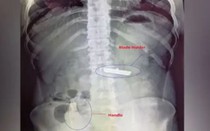 Phẫu thuật cho nam thanh niên 20 tuổi, bác sĩ sốc nặng khi lấy ra "thứ nguy hiểm"