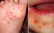 Đã có 3 ca tử vong do bệnh tay chân miệng