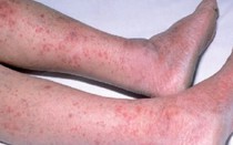 Hà Nội đã có ca mắc viêm não mô cầu, bác sĩ chỉ rõ dấu hiệu nhận biết bệnh