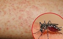 Đã có 62 ca tử vong do sốt xuất huyết, bác sĩ cảnh báo nguy hiểm khi tự truyền nước tại nhà