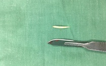 Suýt mất mạng vì hóc xương cá