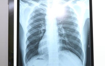 Bác sĩ kinh ngạc gặp bệnh nhân đau ruột thừa có tim, dạ dày đảo ngược