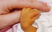 Cha mẹ xem thường bệnh vàng da, trẻ sơ sinh 7 ngày tuổi phải thay máu