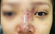 Nguy hại khi tiêm chất làm đầy filler, hệ lụy từ đâu?