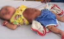 Bé 5 tháng tuổi lở loét khắp người tưởng bị chân tay miệng, nào ngờ con mắc bệnh hiếm
