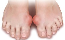 Chuyên gia cung cấp kiến thức tổng quan về bệnh gout và cách phòng ngừa hiệu quả