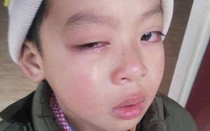 Lạng Sơn: Học sinh có nguy cơ bị mù vì bị giáo viên đánh, công an vào cuộc điều tra