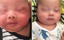 Bé trai 4 tháng nhiễm tụ cầu bị loét da mặt vì mẹ đắp thuốc lá theo dân gian