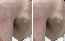 Tạm đình chỉ giáo viên đánh học sinh lớp 3 bầm dập ở lưng