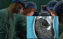 Kỳ lạ hội chứng “nghiện ăn tóc” và cảnh báo từ bác sĩ