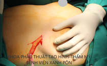 Hãi hùng lời kể của bác sĩ chuyên trùng tu vòng 1 của các chị em làm đẹp hỏng