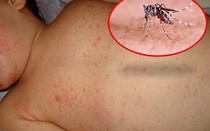 Bà Rịa - Vũng Tàu ghi nhận trường hợp thứ 5 tử vong do sốt xuất huyết