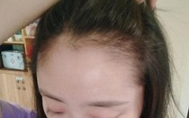 Cô gái mắc bệnh trọng vì rụng tóc quá nhiều