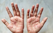 Bệnh đậu mùa khỉ lây truyền từ người sang người như thế nào?