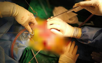 Kịp thời cứu sống bé gái hơn 1 tuổi bị mảnh cốc cắm thủng bụng