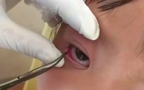 Khám mắt cho bé gái người Mông, bác sĩ phát hiện một con vắt