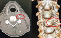 Uống nước “bà mo” chữa bệnh, người đàn ông nhập viện do hóc xương cá