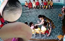 Phẫn nộ giáo viên hợp đồng tự ý mở lớp hè, đánh nhiều lần vào đầu trẻ do… dạy không được