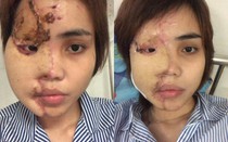 Mức án nào dành cho cựu thiếu úy công an tạt axit vợ sắp cưới?
