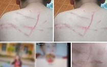 Bản tin 3/10: Học sinh lớp 4 bị cô giáo đánh "không thương tiếc"