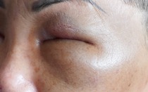 Nửa đêm cấp cứu vì vào nhà nghỉ tiêm filler làm đẹp giá rẻ