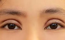 Những biến chứng có thể xảy ra sau cắt mí và cách khắc phục