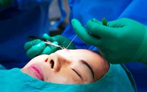 Điểm đặc biệt trong kỹ thuật cắt mí nâng cơ tại viện thẩm mỹ D’Vincy