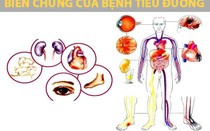 Các nguyên nhân gây bệnh tiểu đường thường gặp