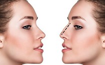 Có nên phẫu thuật thẩm mỹ không và lời giải trấn an dư luận