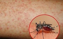 Ghi nhận một trường hợp trẻ tử vong do bệnh sốt xuất huyết Dengue