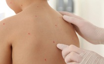Ghi nhận ổ dịch thủy đậu tại một trường mầm non ở Đắk Lắk