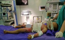 Cách sơ cứu khi trẻ bị bỏng nước sôi